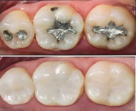 RESTAURAÇÕES EM DENTES POSTERIORES