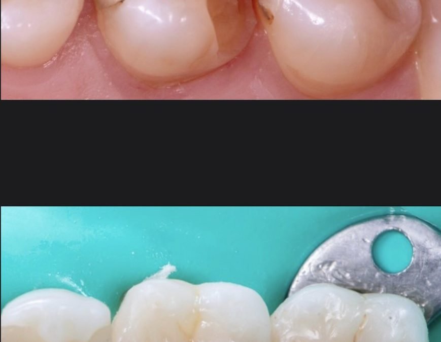 RESTAURAÇÃO DIRETA