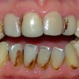 ALIMENTOS QUE MANCHAM OS DENTES